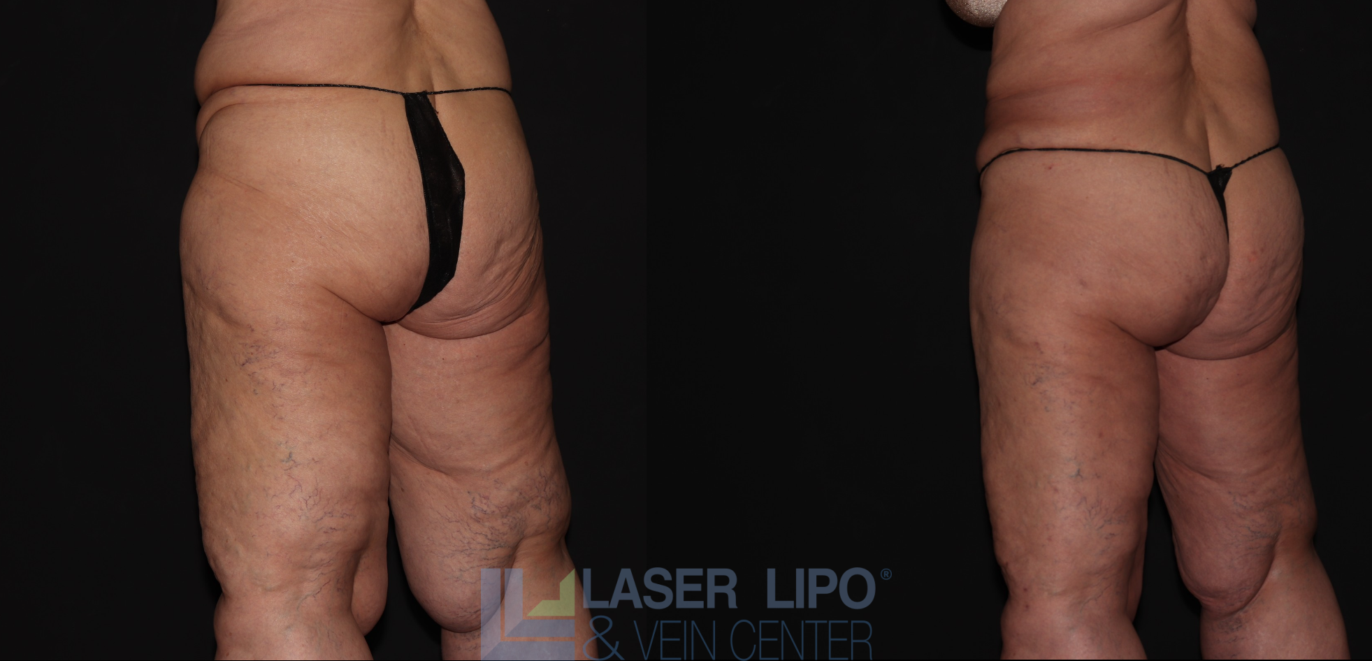 Before and After Image: Stage 3 – Thighs - left-back-oblique
