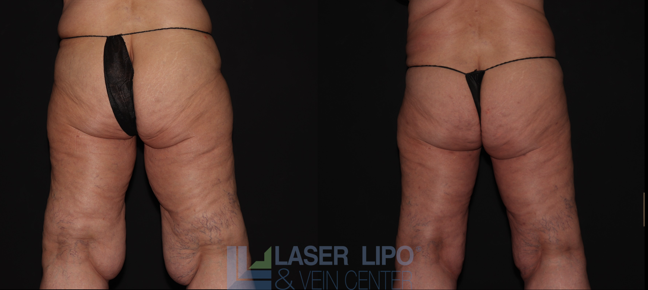 Before and After Image: Stage 3 – Thighs - back