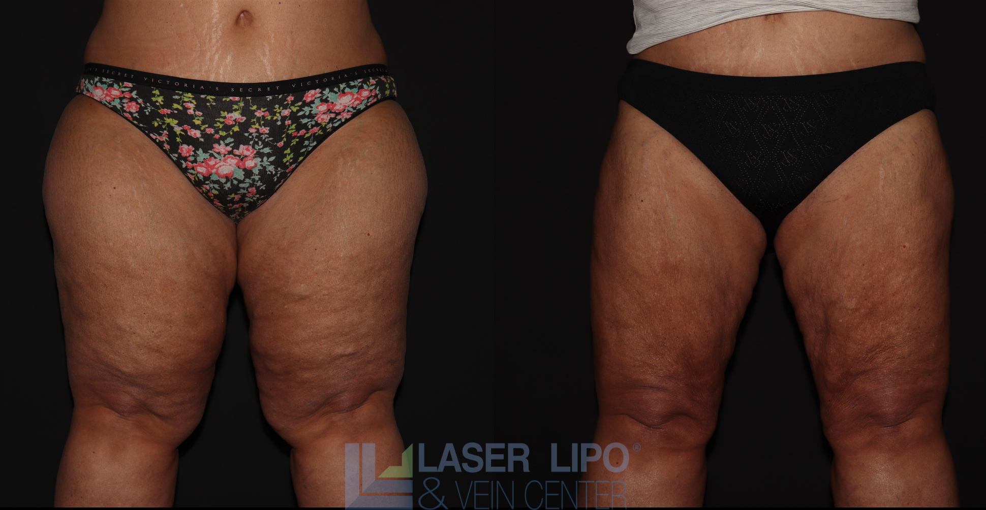 Before and After Image: Stage 3 – Thighs - front