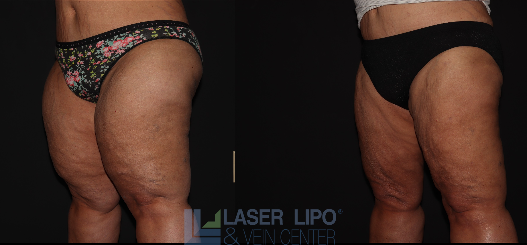 Before and After Image: Stage 3 – Thighs - left-front-oblique