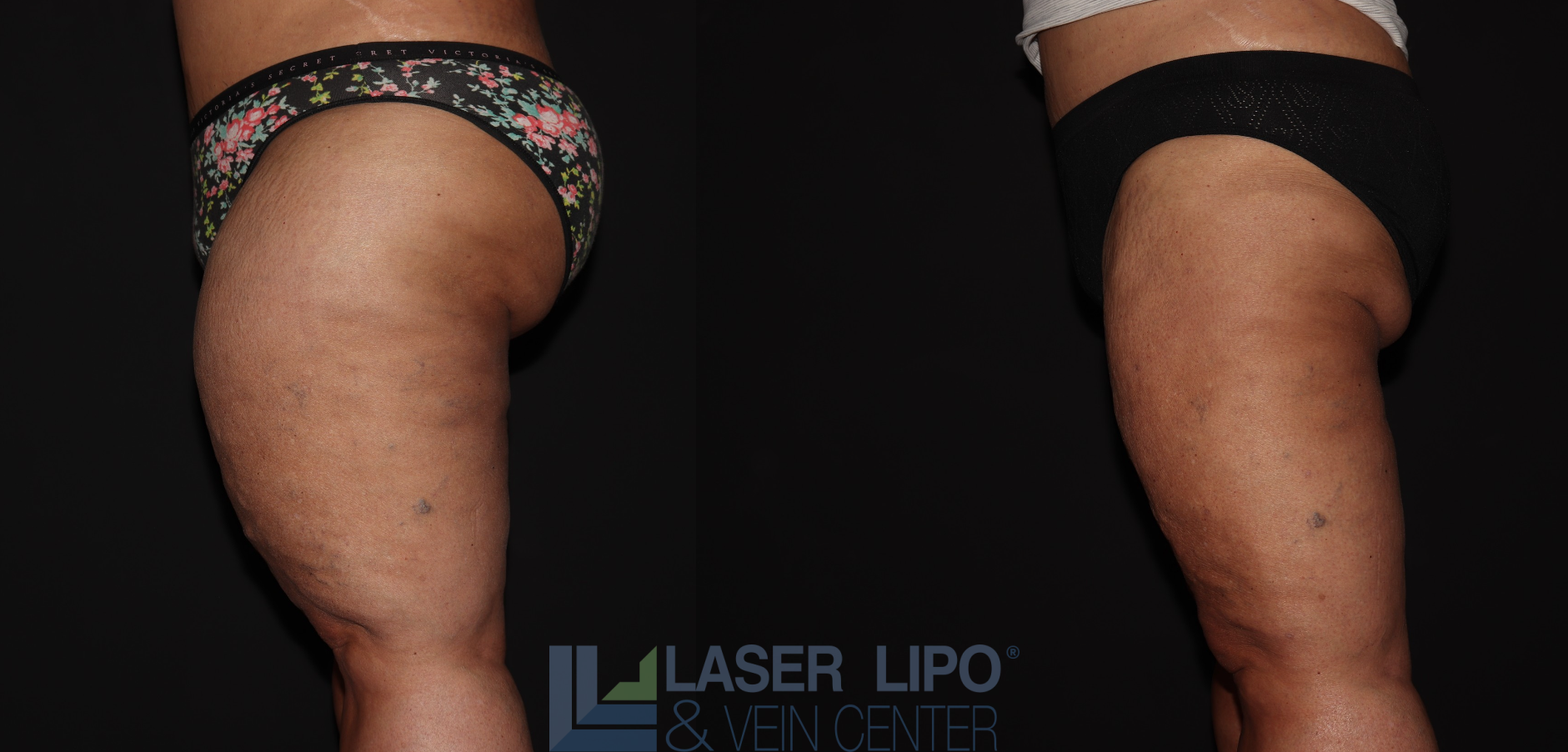 Before and After Image: Stage 3 – Thighs - left-side