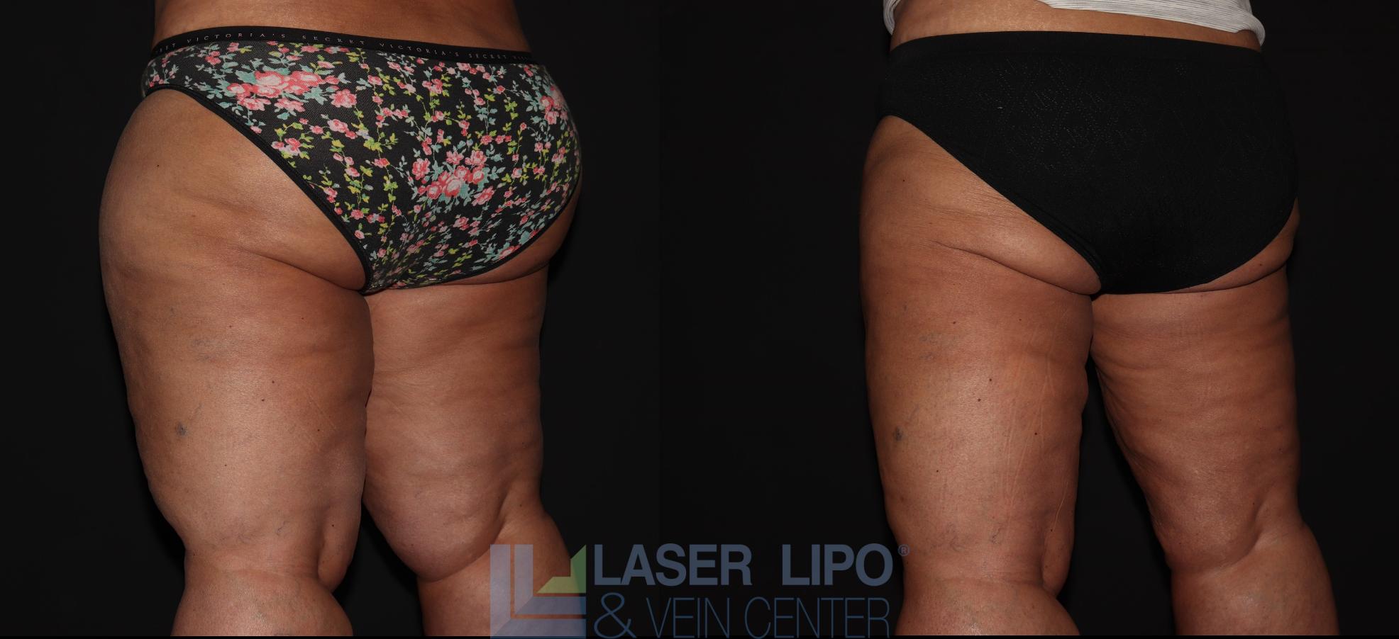 Before and After Image: Stage 3 – Thighs - left-back-oblique