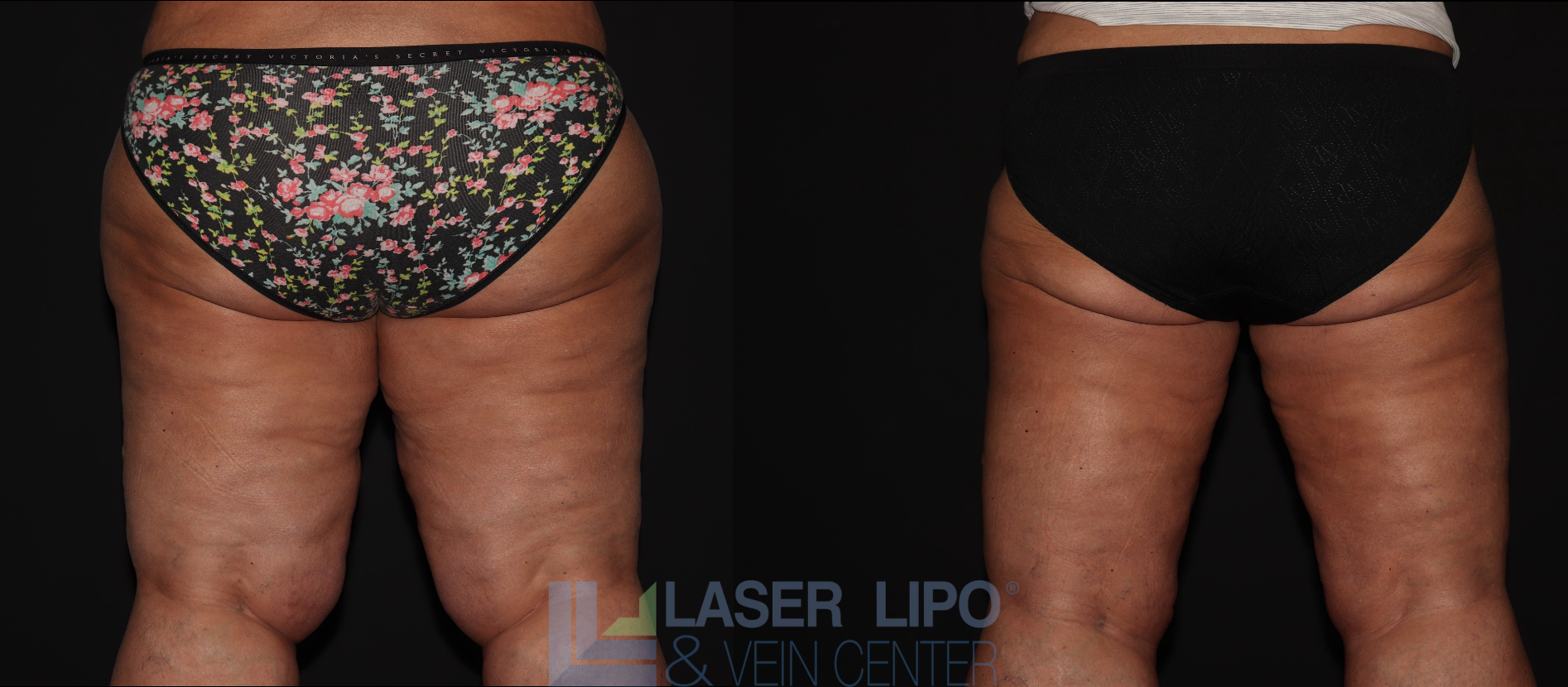 Before and After Image: Stage 3 – Thighs - back