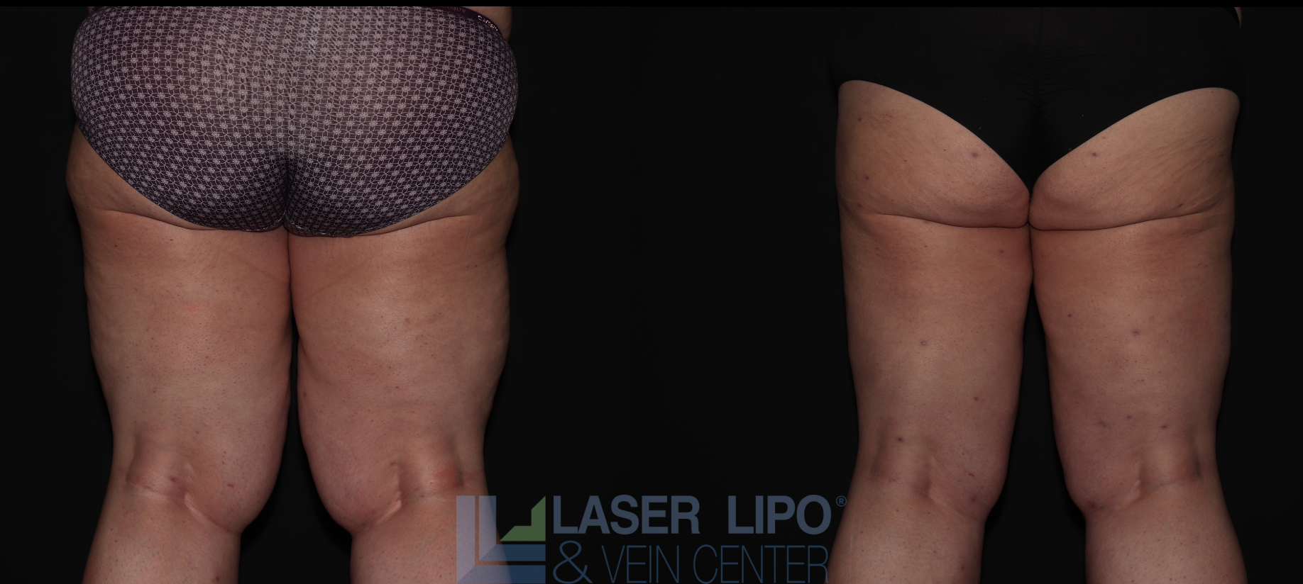 Before and After Image: Stage 3 – Thighs - back