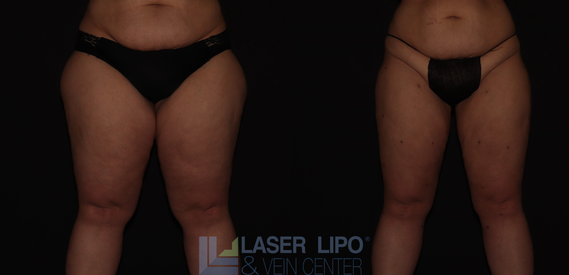 Before and After Image: Stage 3 – Thighs - front
