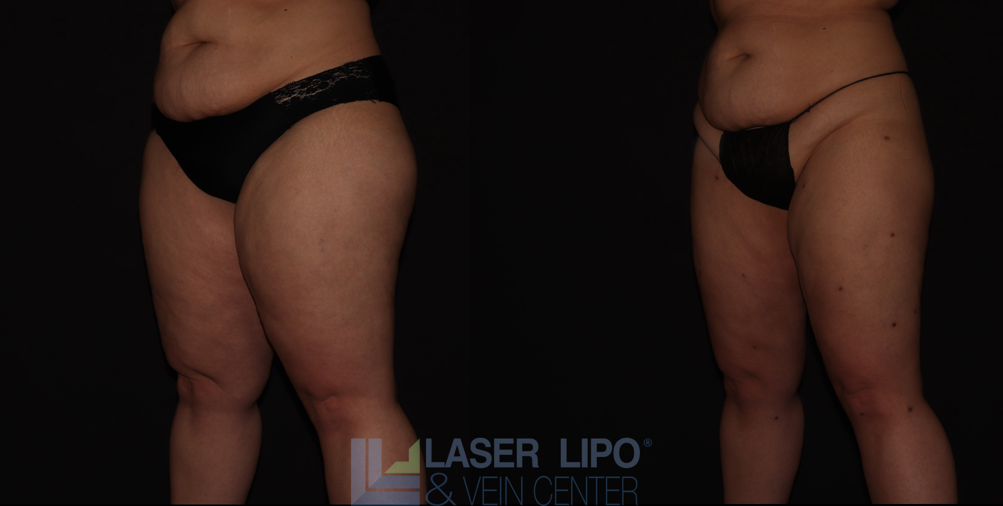 Before and After Image: Stage 3 – Thighs - left-front-oblique