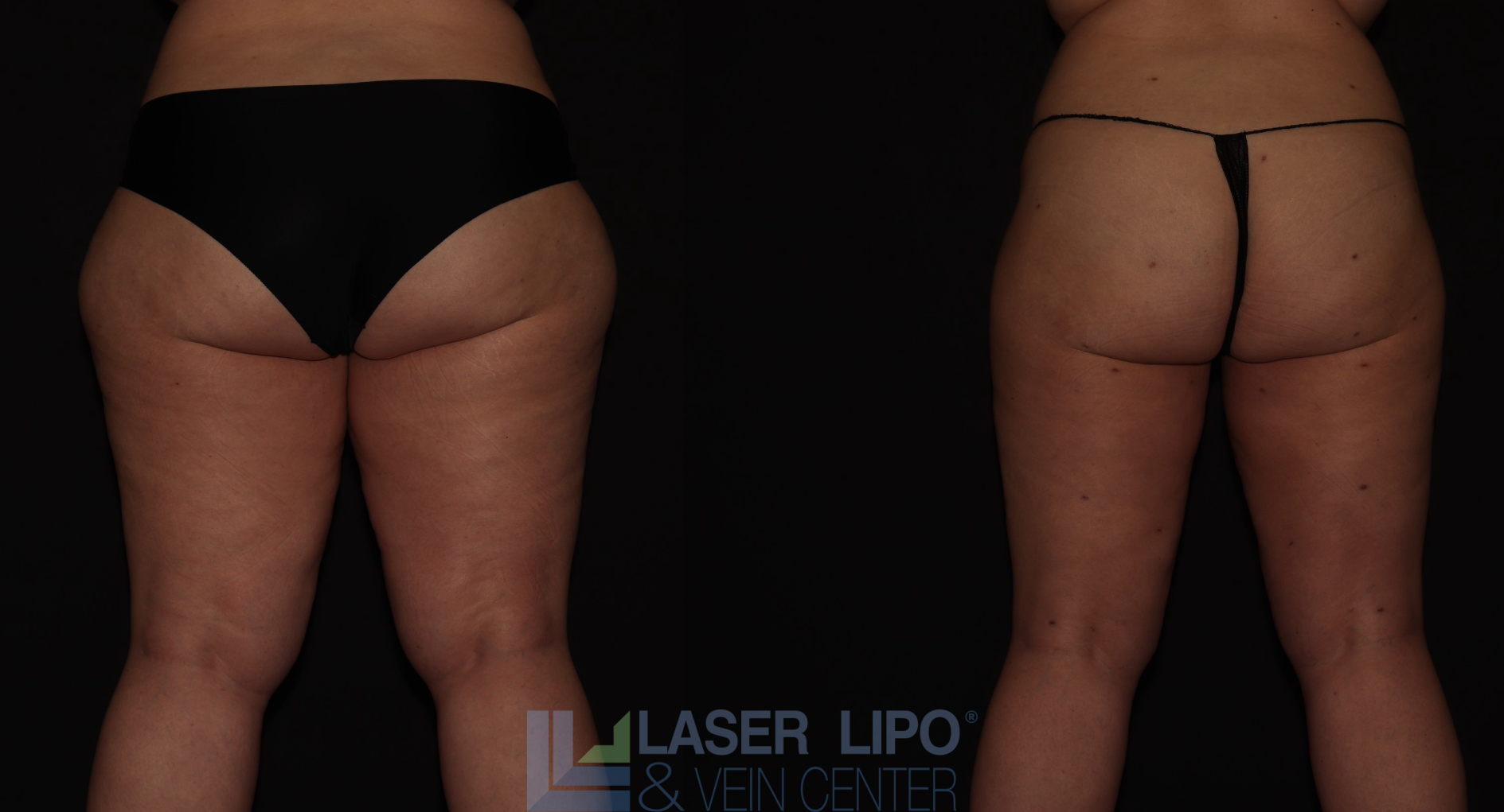 Before and After Image: Stage 3 – Thighs - back