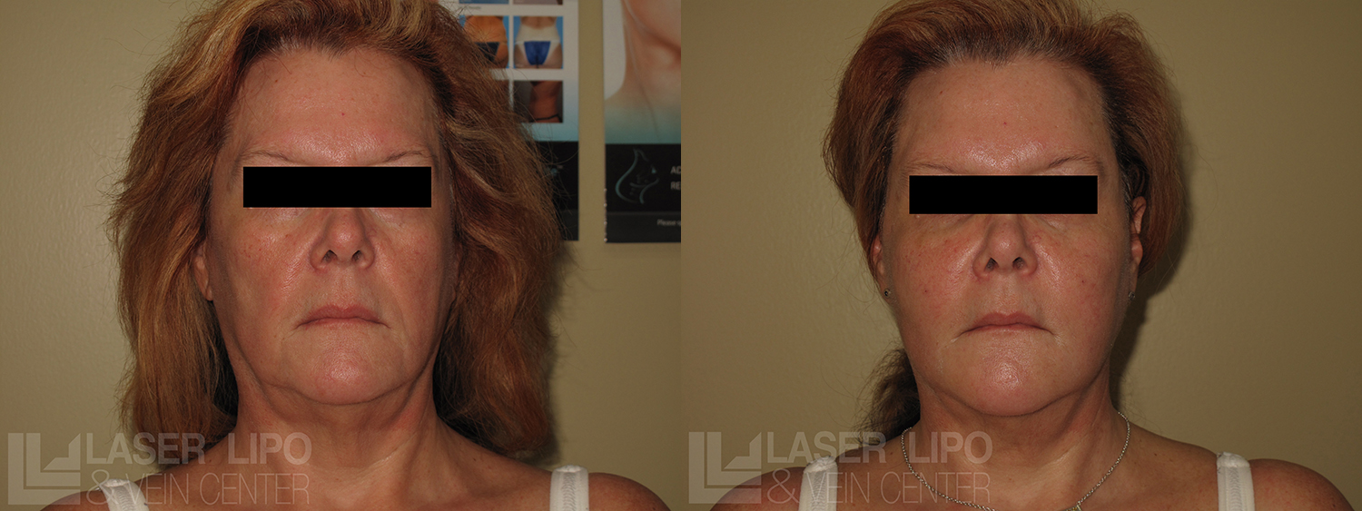 Before and After Image: Fat Transfer to Face - front