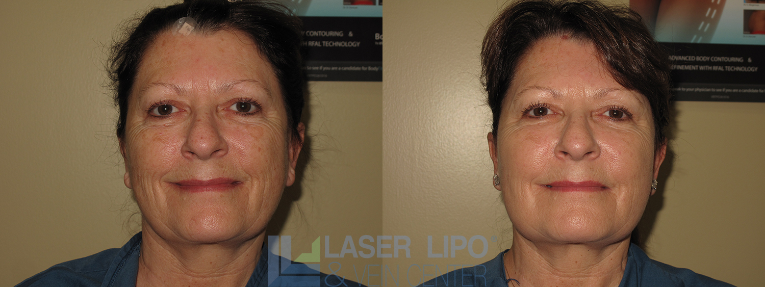 Before and After Image: Fat Transfer to Face - front