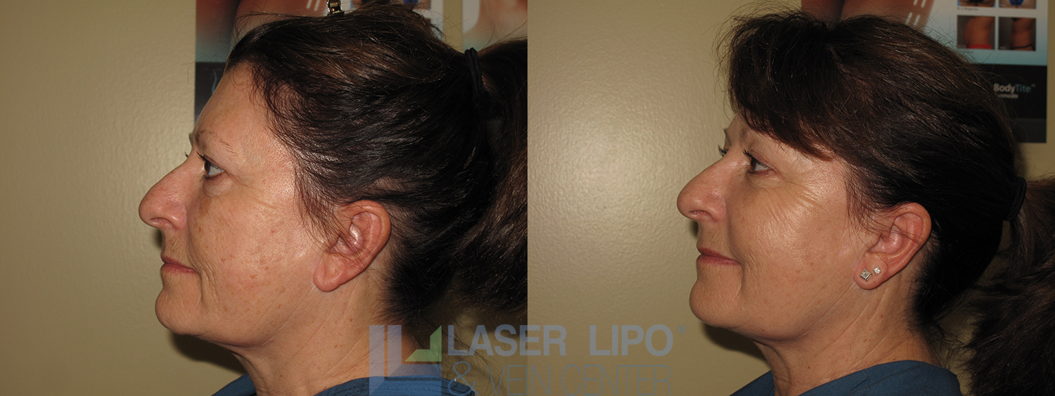 Before and After Image: Fat Transfer to Face - left-side