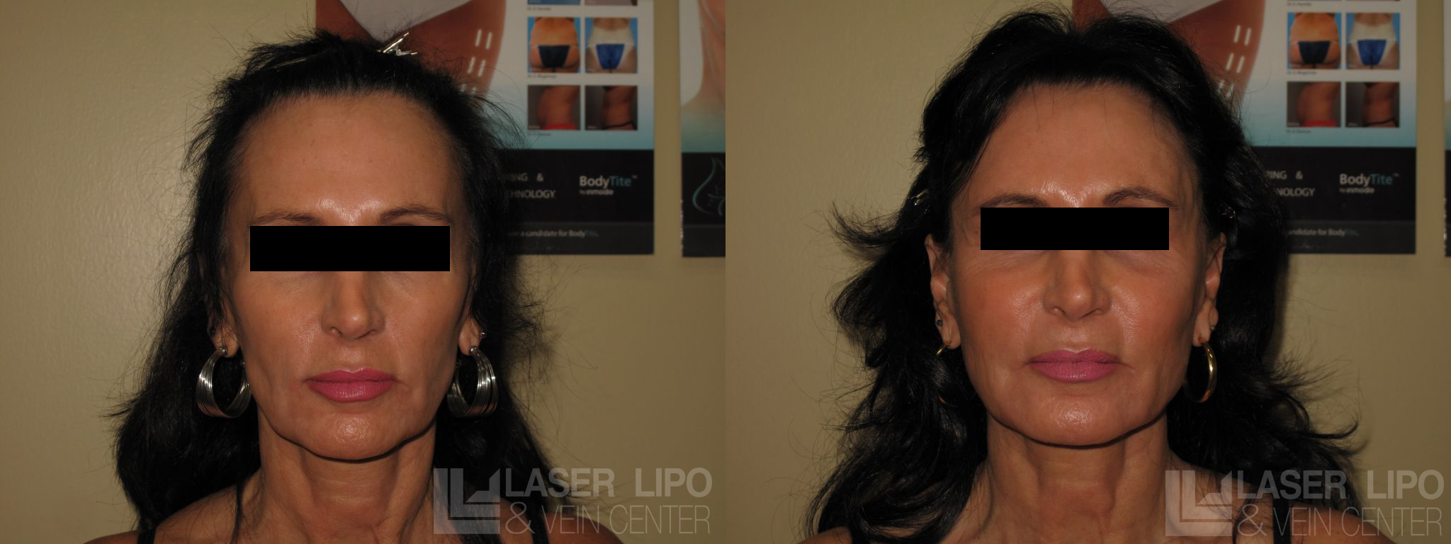 Before and After Image: Fat Transfer to Face - front