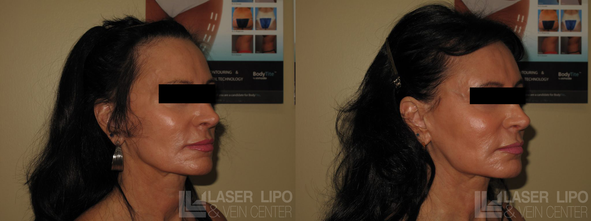 Before and After Image: Fat Transfer to Face - right-front-oblique