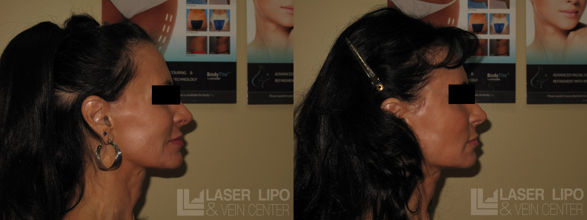Before and After Image: Fat Transfer to Face - right-side