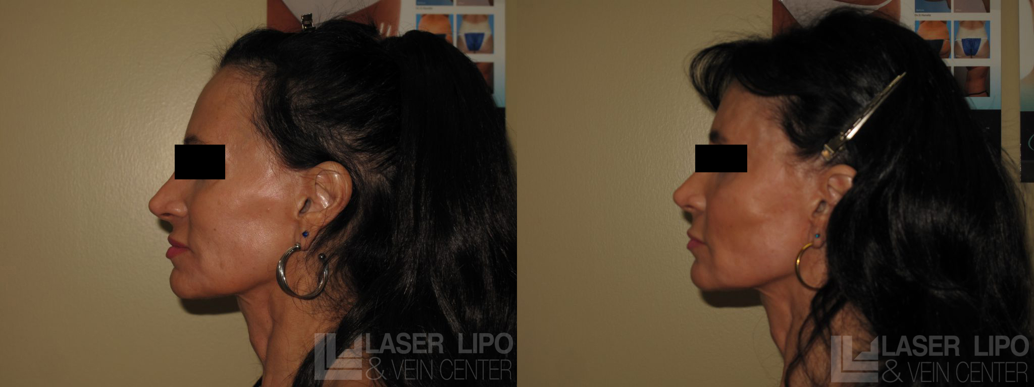 Before and After Image: Fat Transfer to Face - left-side