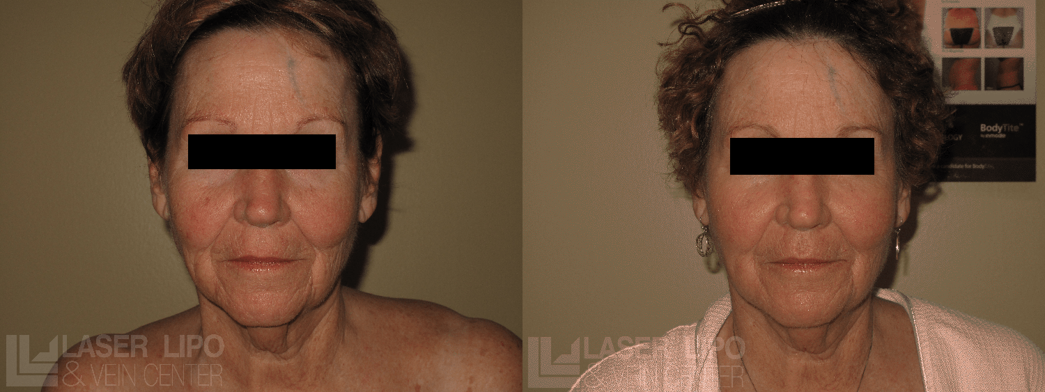 Before and After Image: Fat Transfer to Face - front