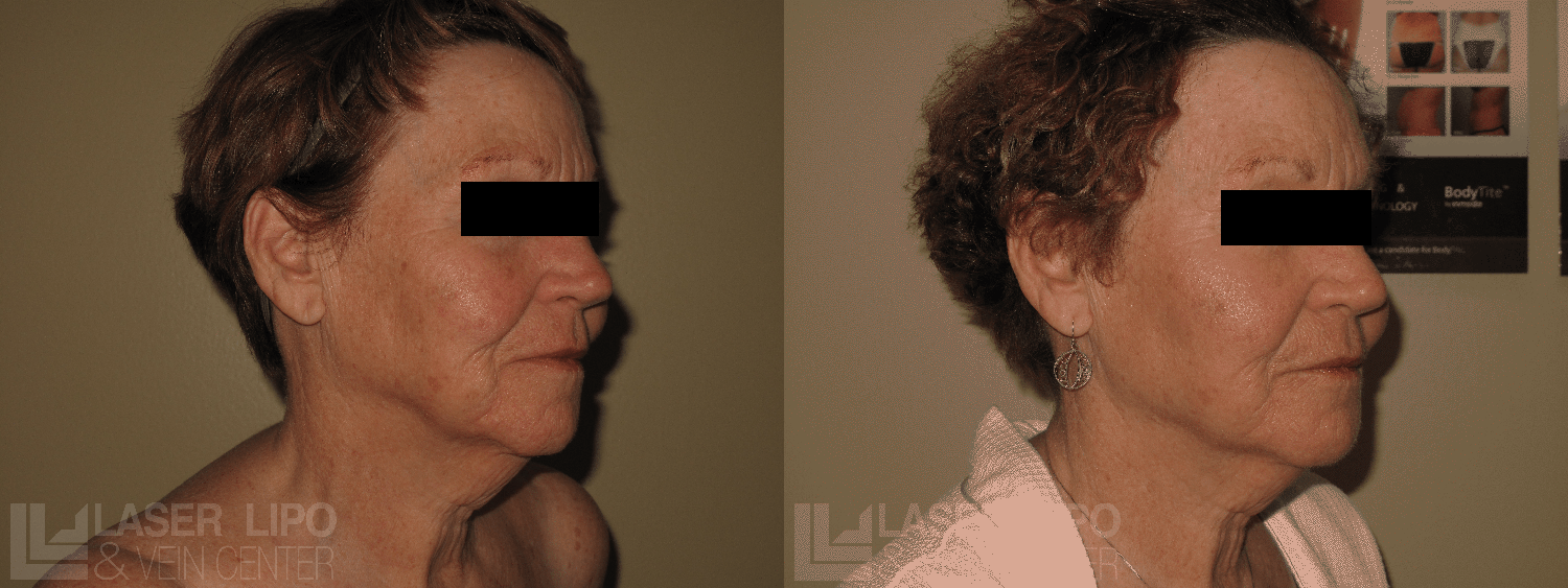 Before and After Image: Fat Transfer to Face - right-front-oblique