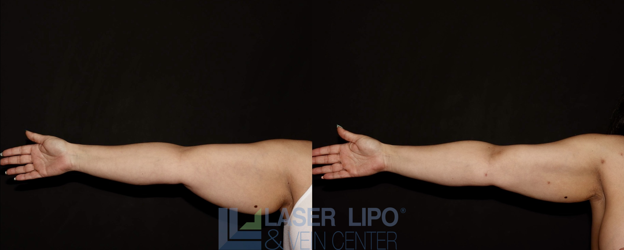 Before and After Image: Liposuction – Arms - front