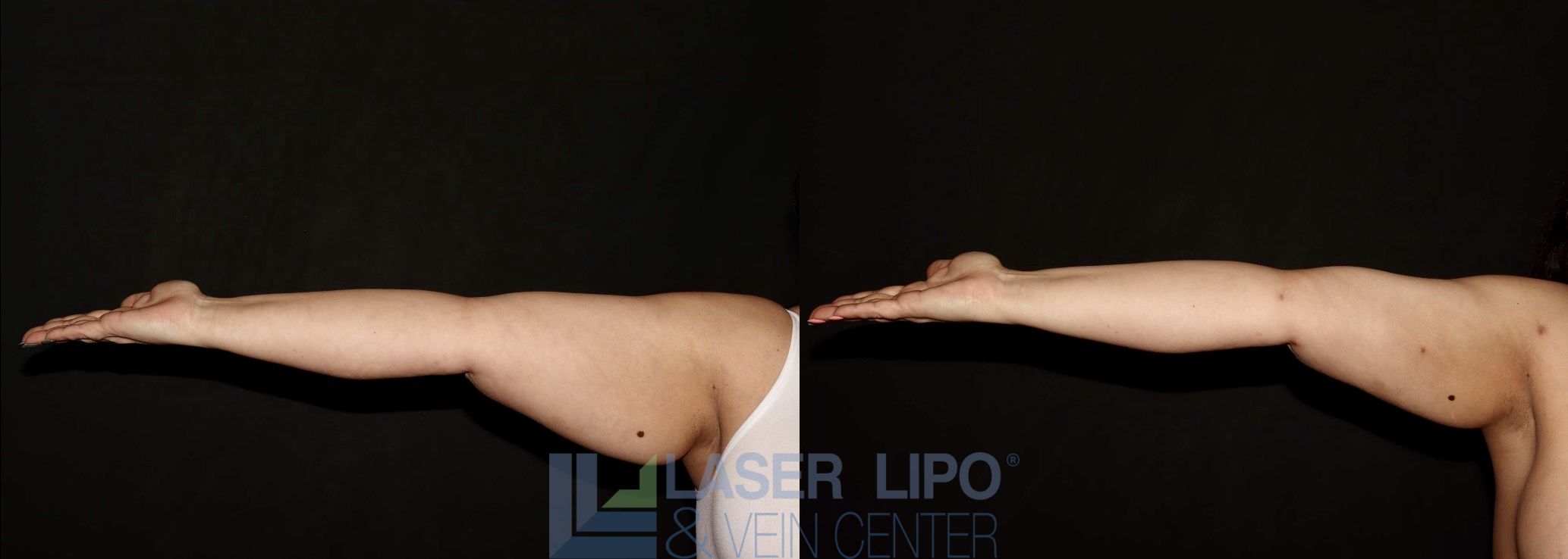 Before and After Image: Liposuction – Arms - front