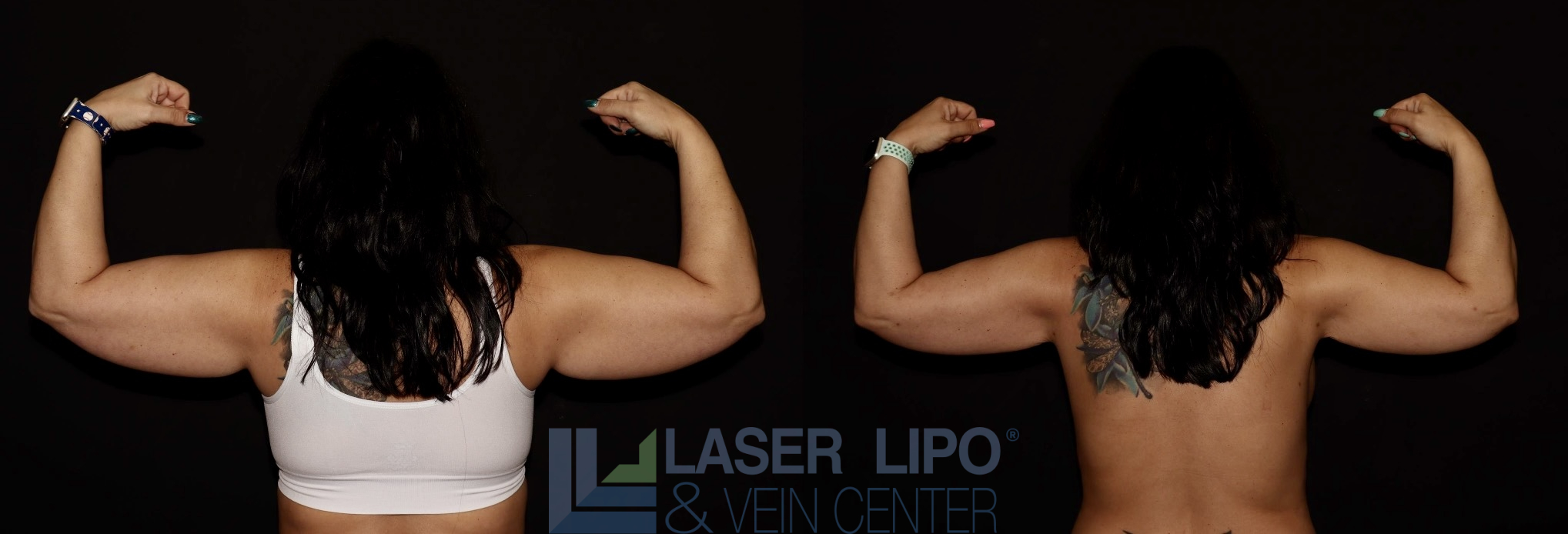 Before and After Image: Liposuction – Arms - back