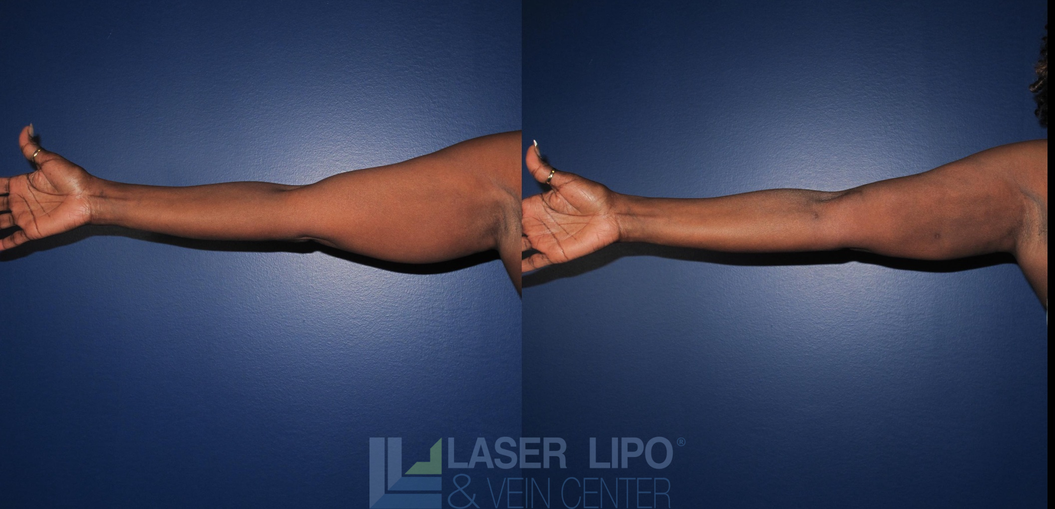 Before and After Image: Liposuction – Arms - front