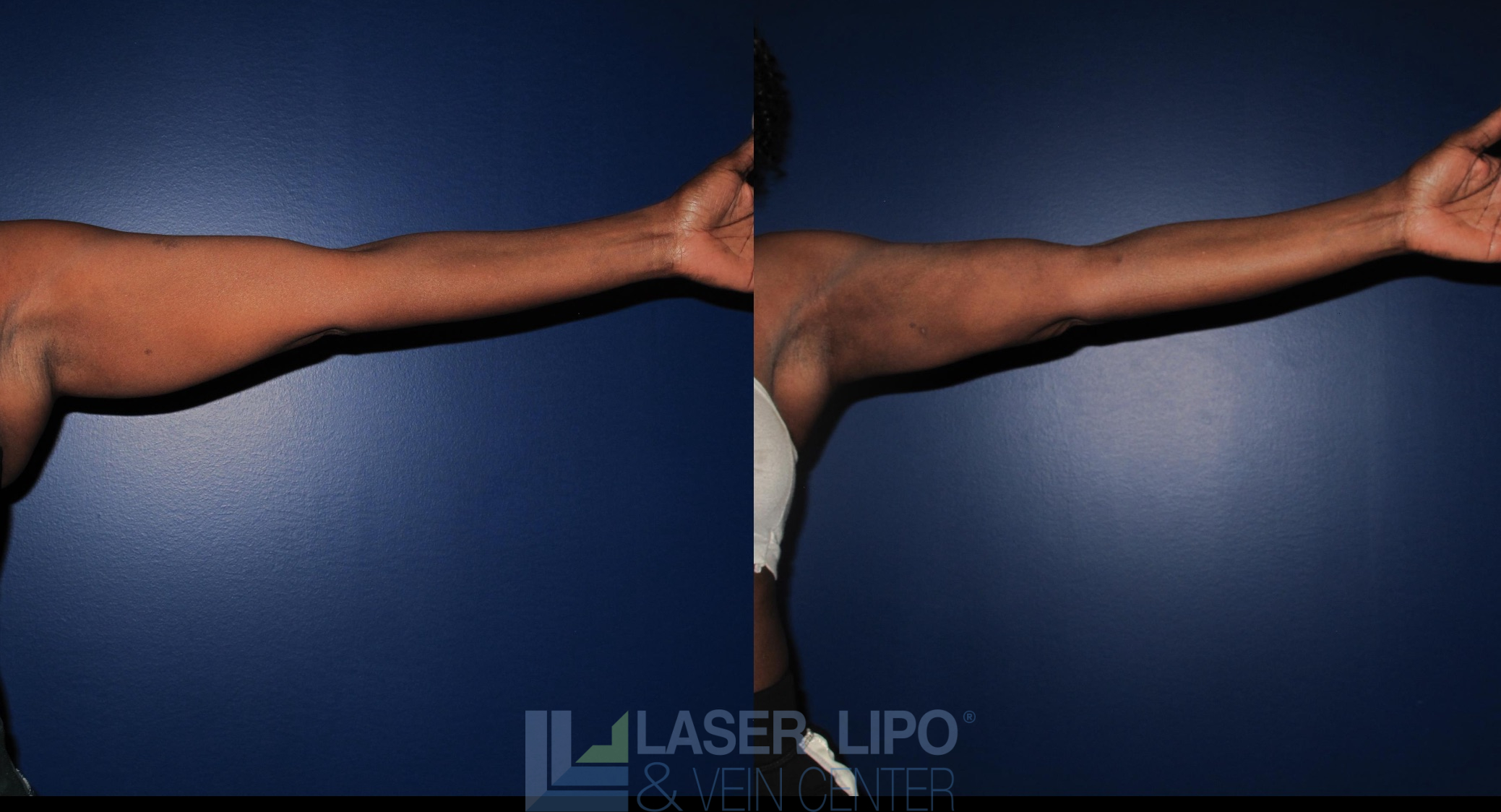 Before and After Image: Liposuction – Arms - front