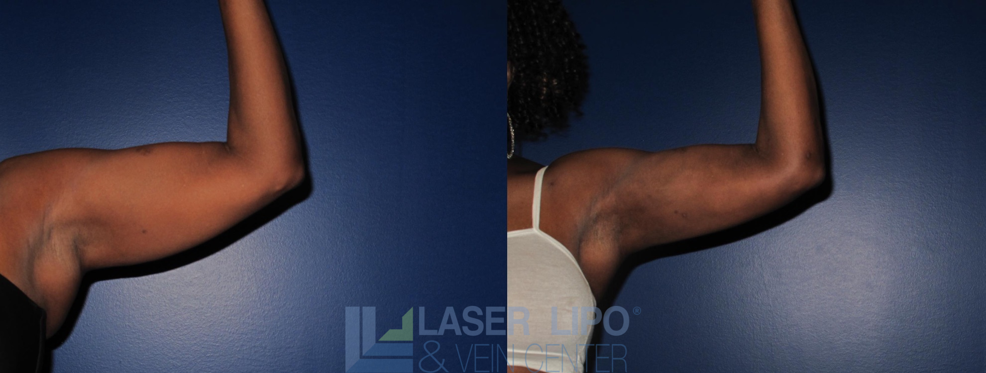 Before and After Image: Liposuction – Arms - front