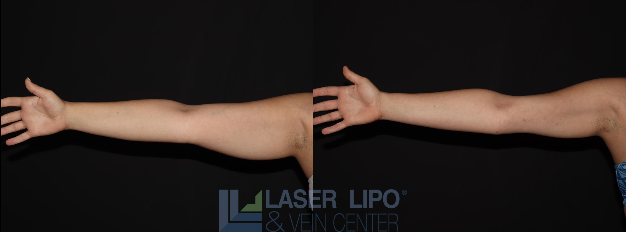 Before and After Image: Liposuction – Arms - front