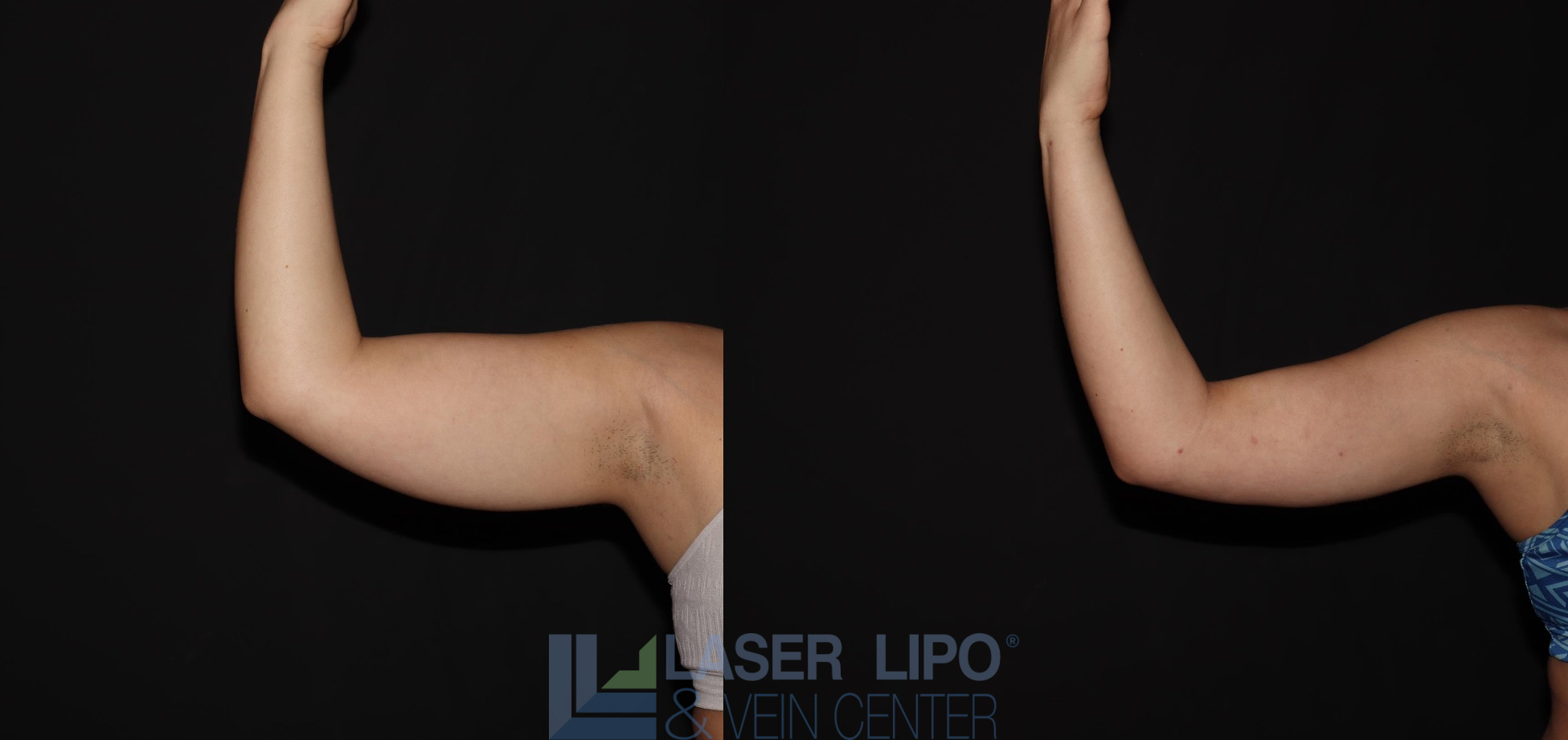 Before and After Image: Liposuction – Arms - front