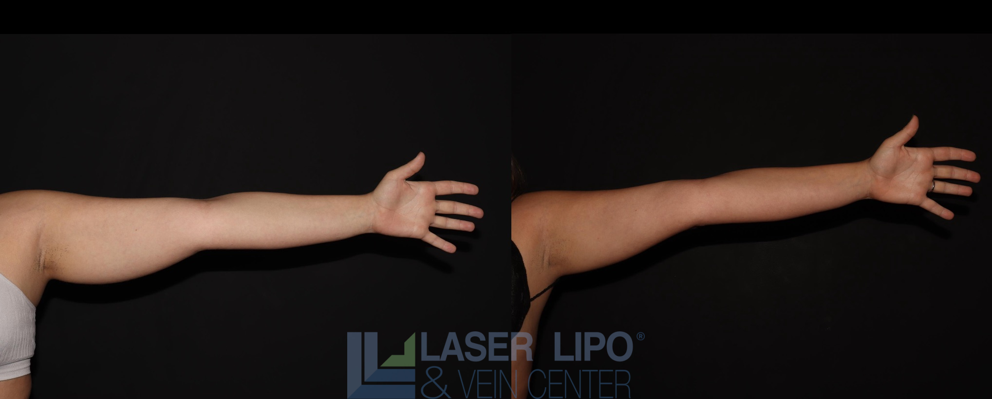 Before and After Image: Liposuction – Arms - front