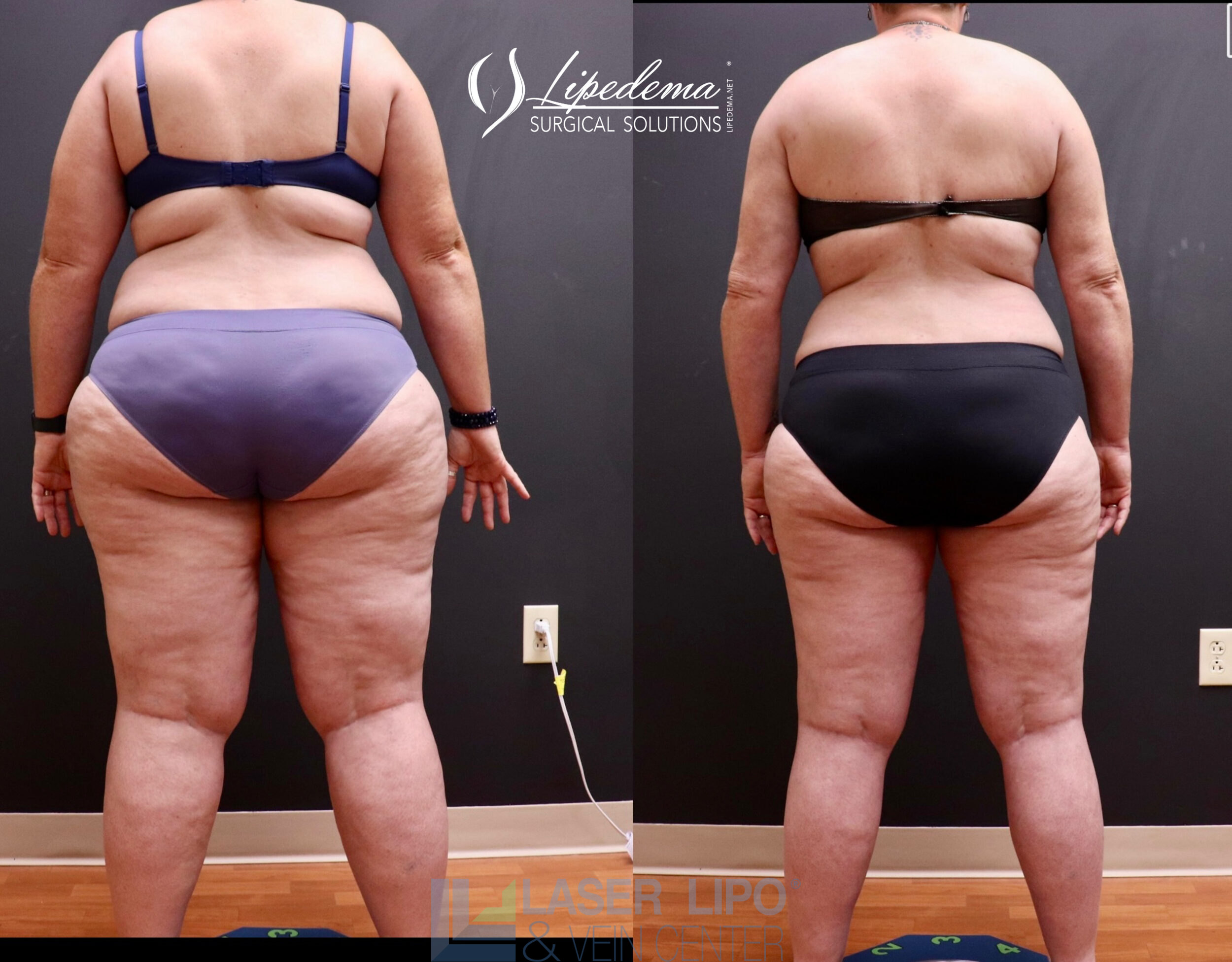 Before and After Image: Lipedema – Full Body - back