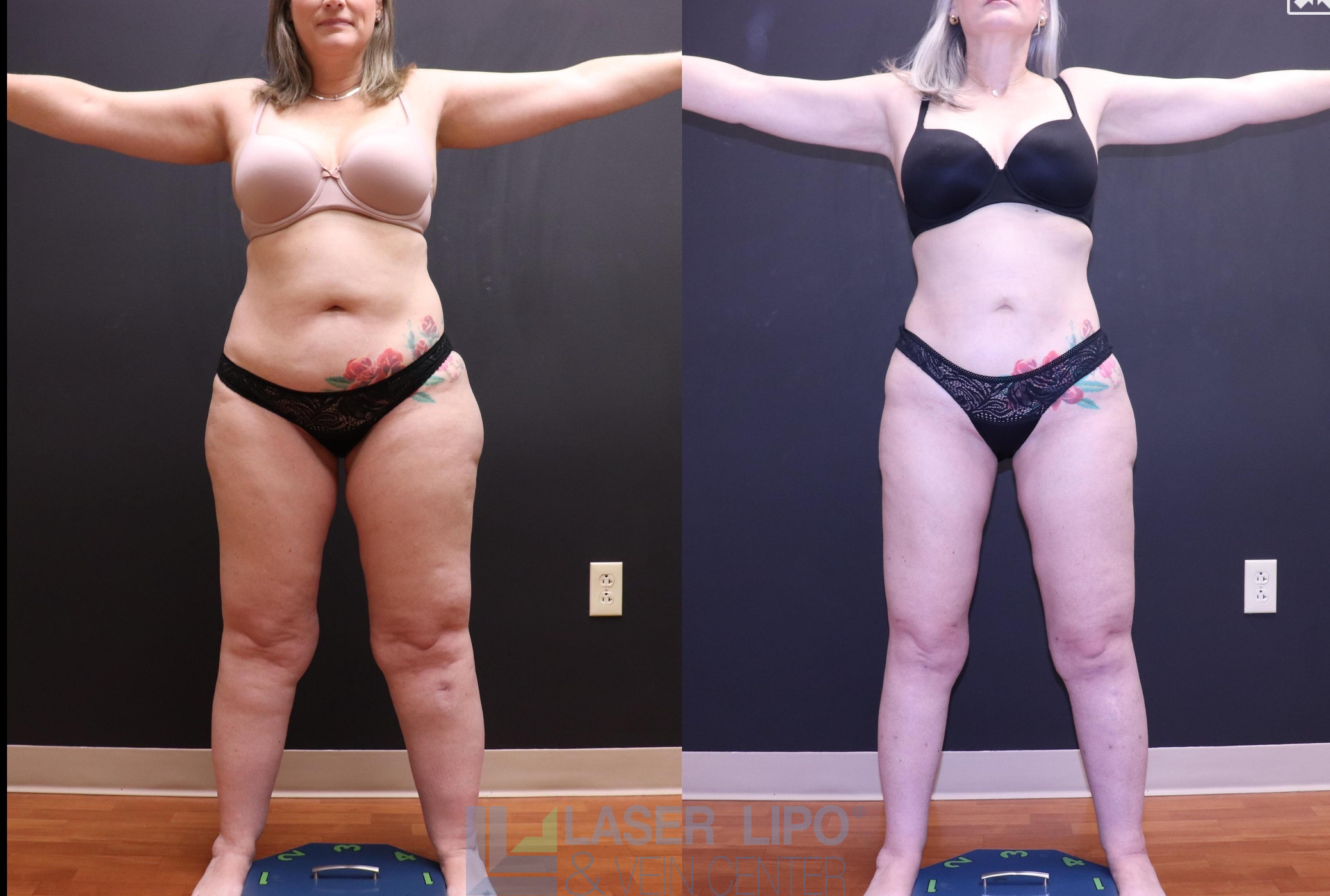 Before and After Image: Lipedema – Full Body - front
