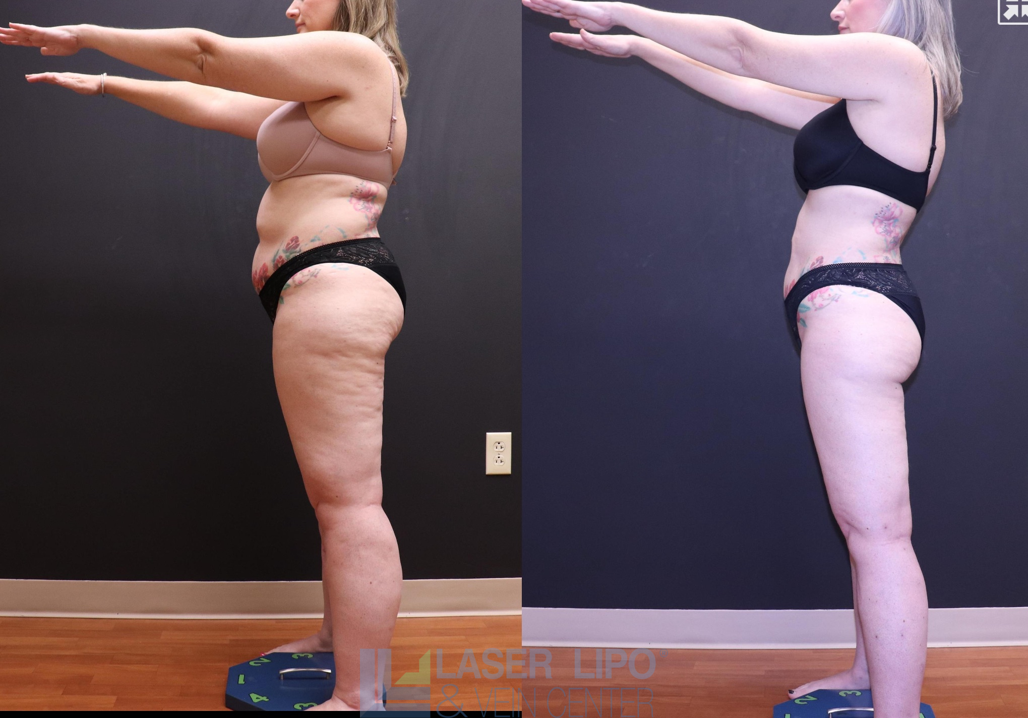 Before and After Image: Lipedema – Full Body - left-side