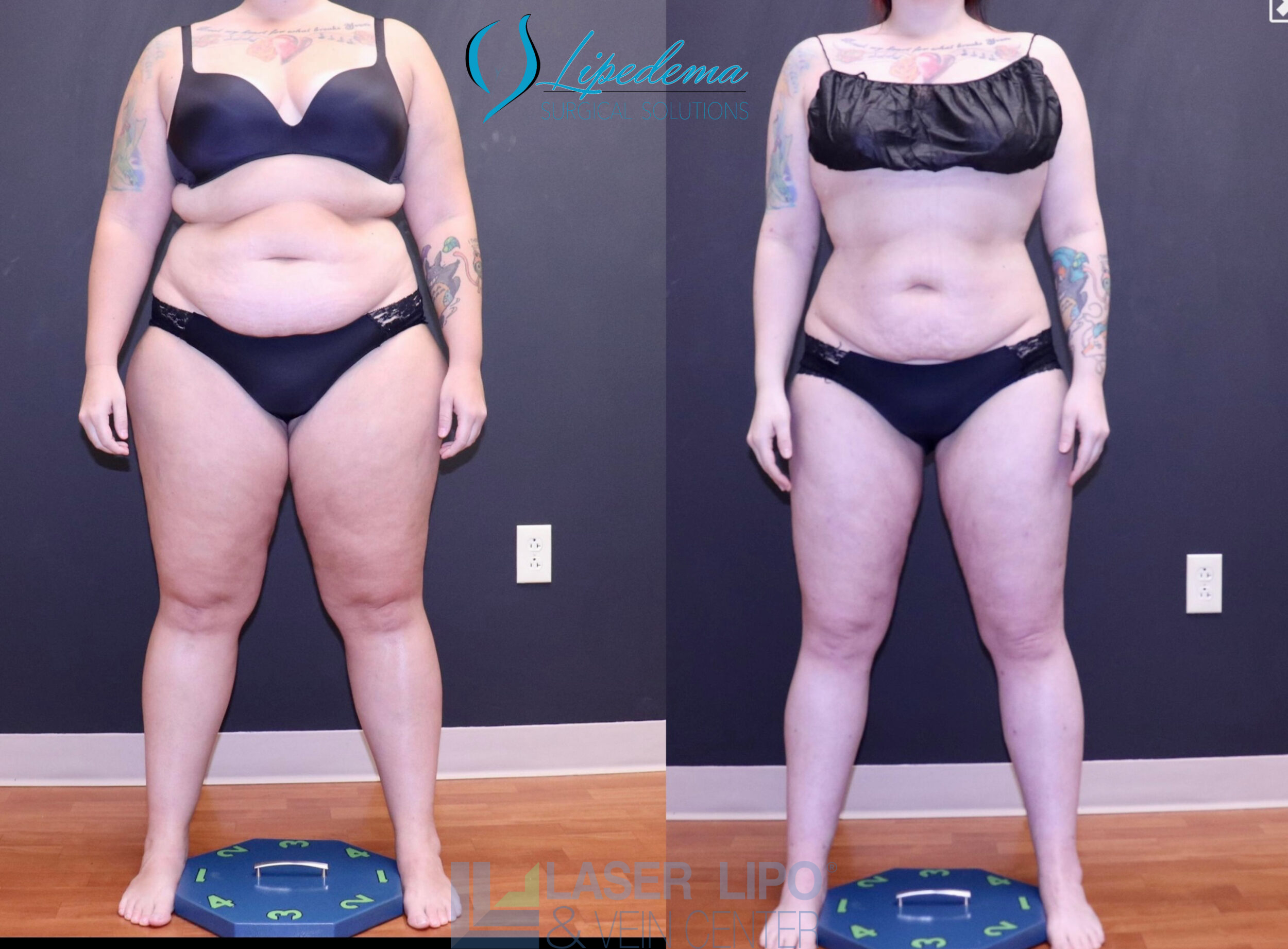 Before and After Image: Lipedema – Full Body - front