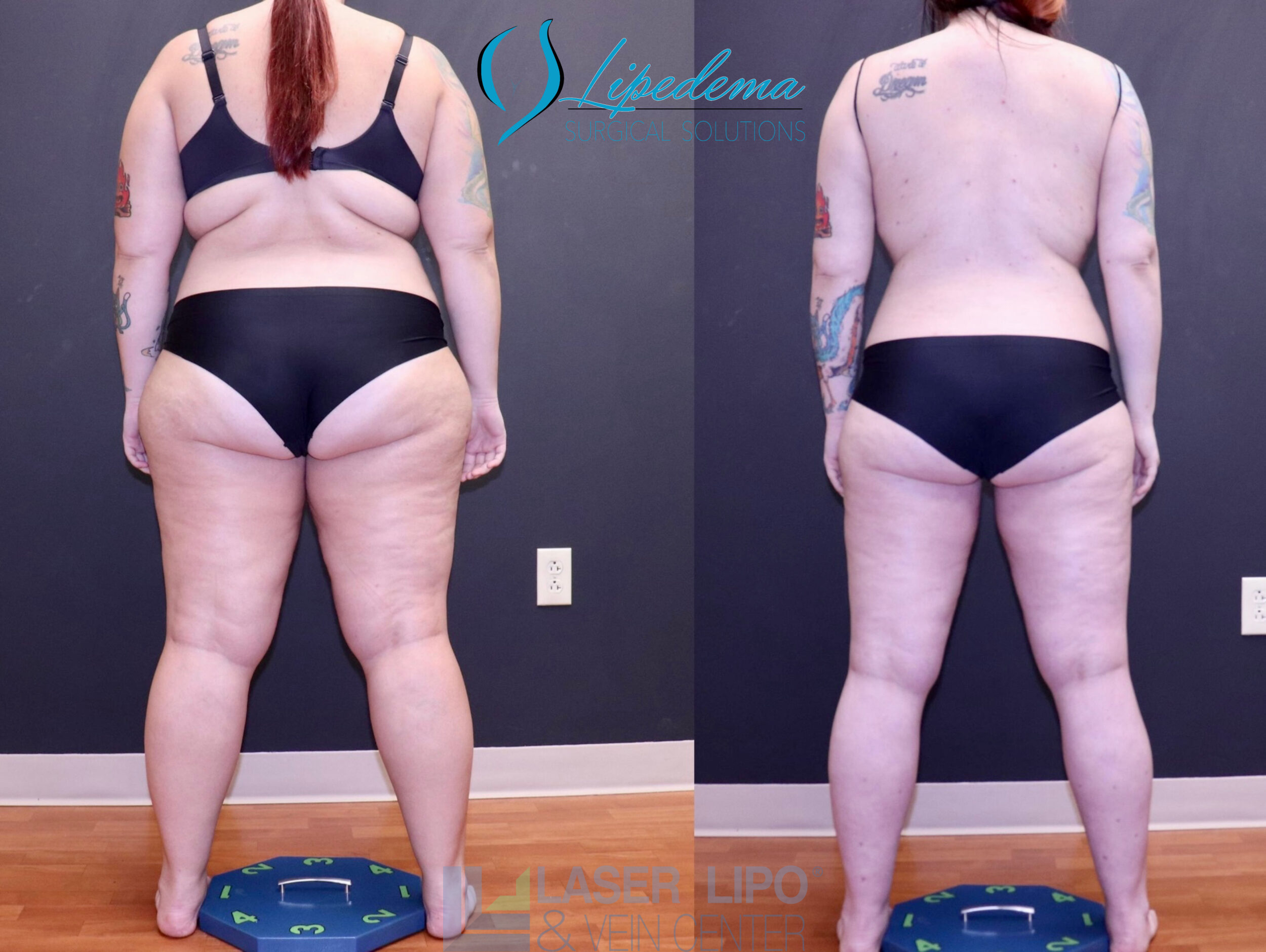 Before and After Image: Lipedema – Full Body - back
