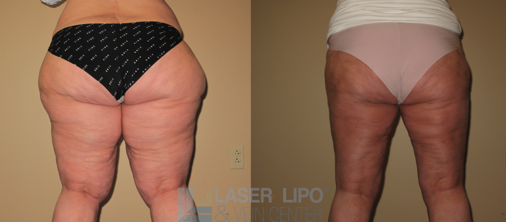 118676 lipedema hips and buttocks c1 1