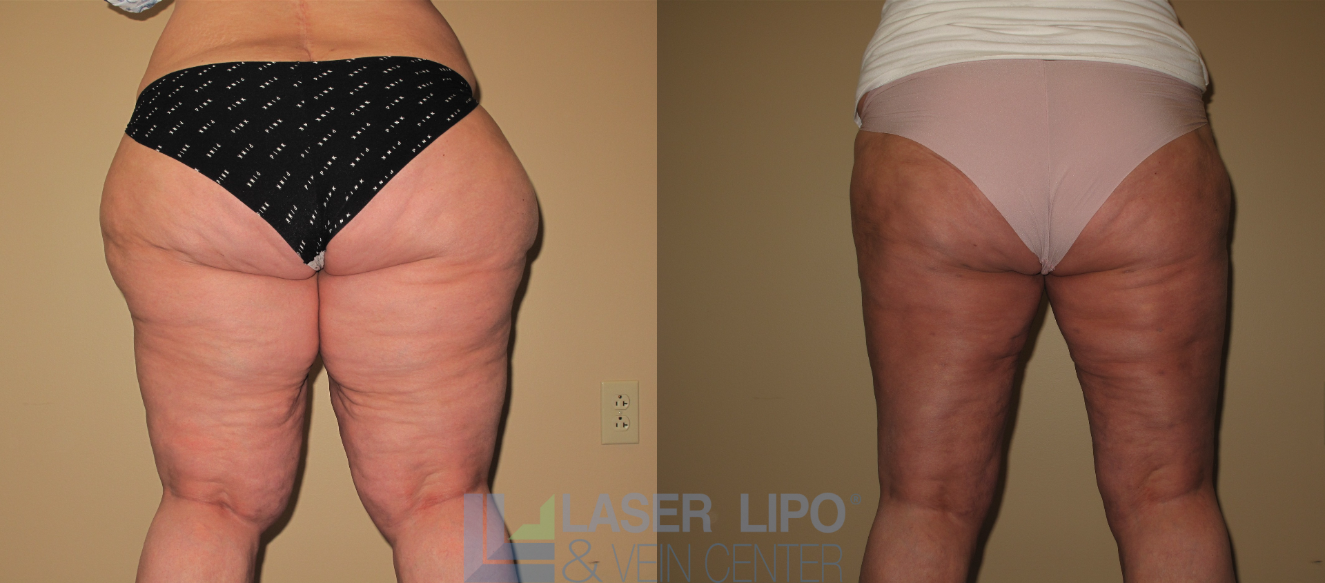 Before and After Image: Lipedema – Hips and Buttocks