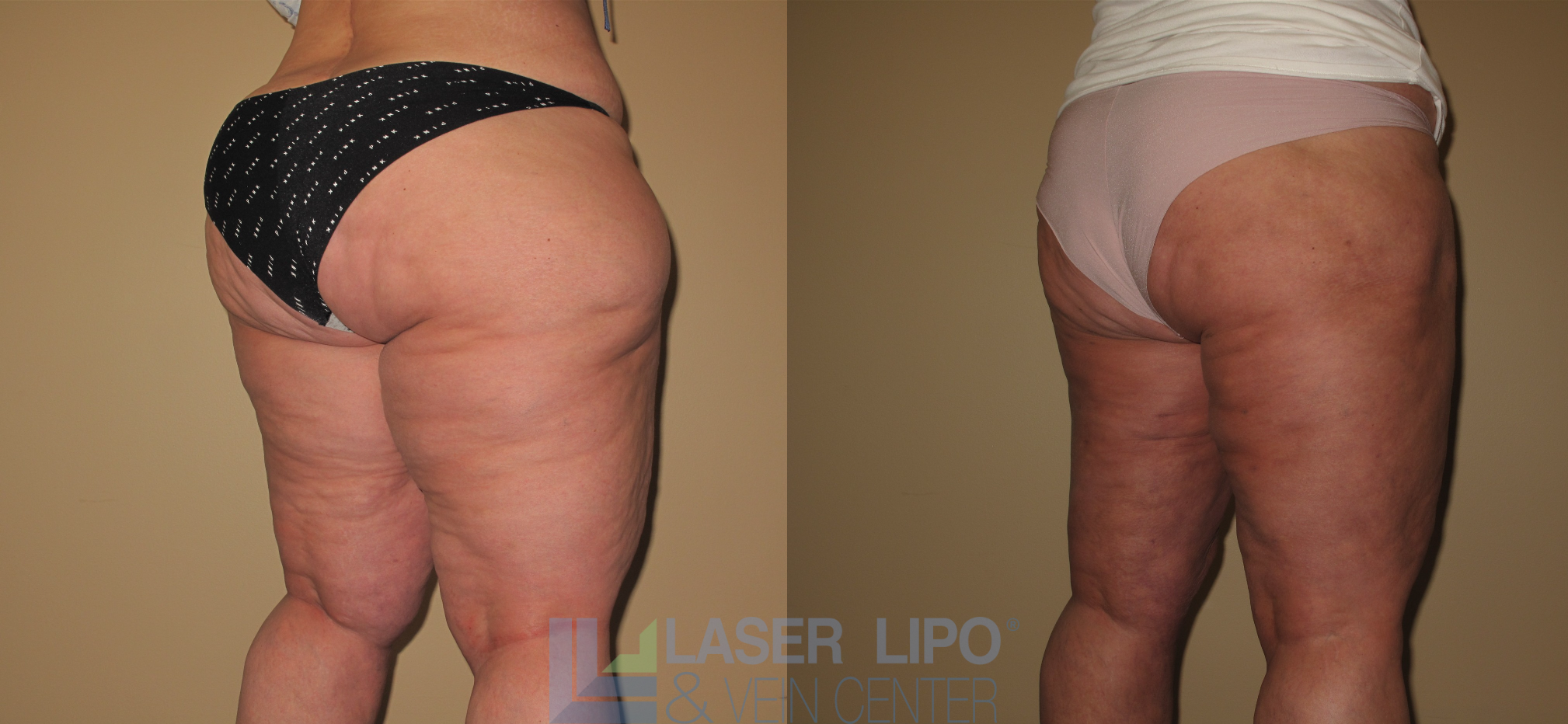 Before and After Image: Lipedema – Hips and Buttocks - right-back-oblique