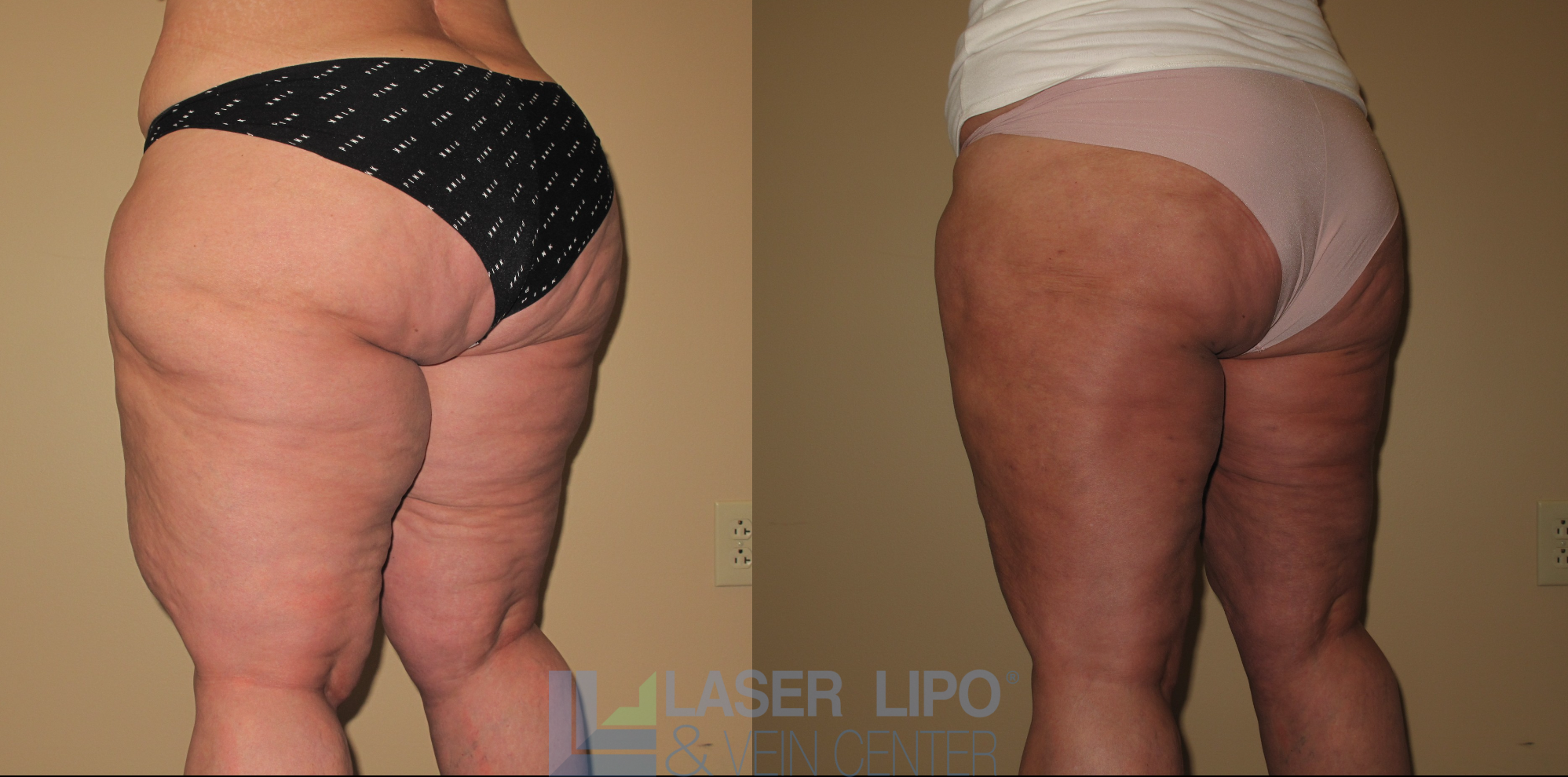Before and After Image: Lipedema – Hips and Buttocks - left-back-oblique