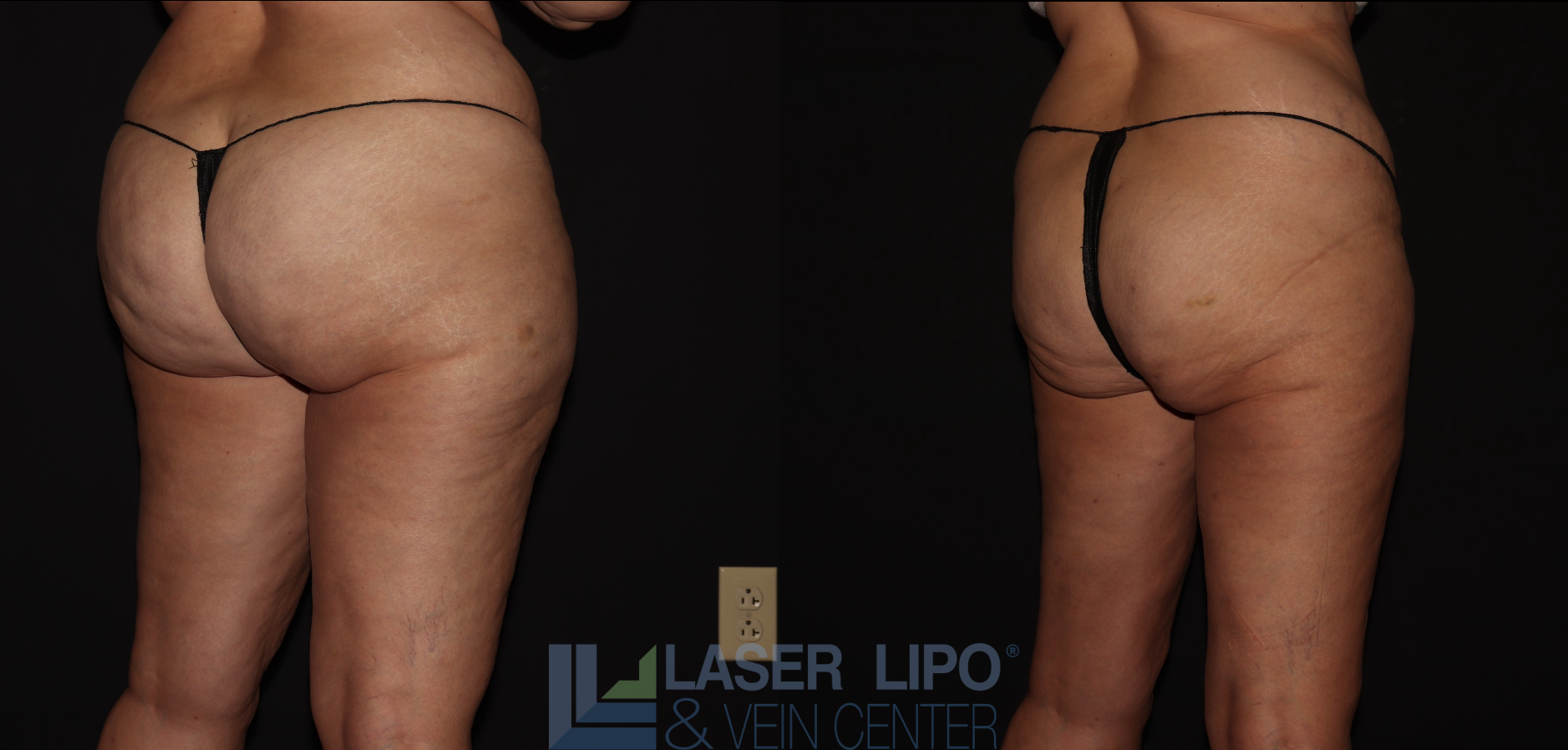 Before and After Image: Lipedema – Hips and Buttocks - right-back-oblique