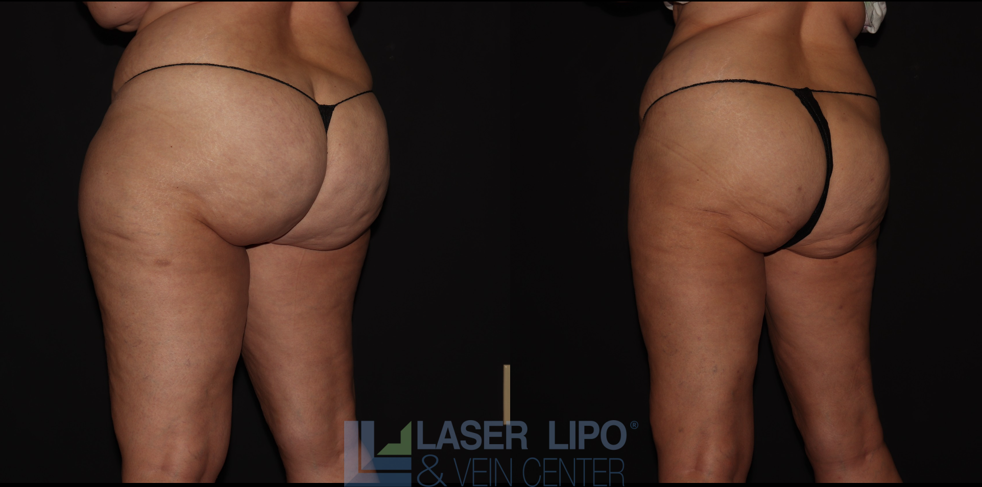 Before and After Image: Lipedema – Hips and Buttocks - left-back-oblique