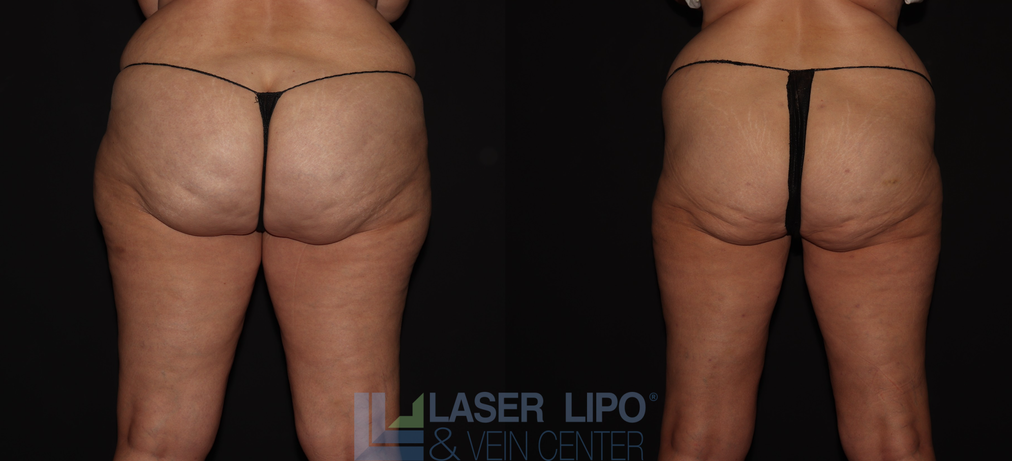 Before and After Image: Lipedema – Hips and Buttocks - back
