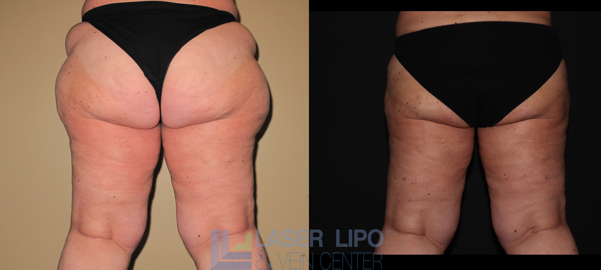 Before and After Image: Lipedema – Hips and Buttocks - back