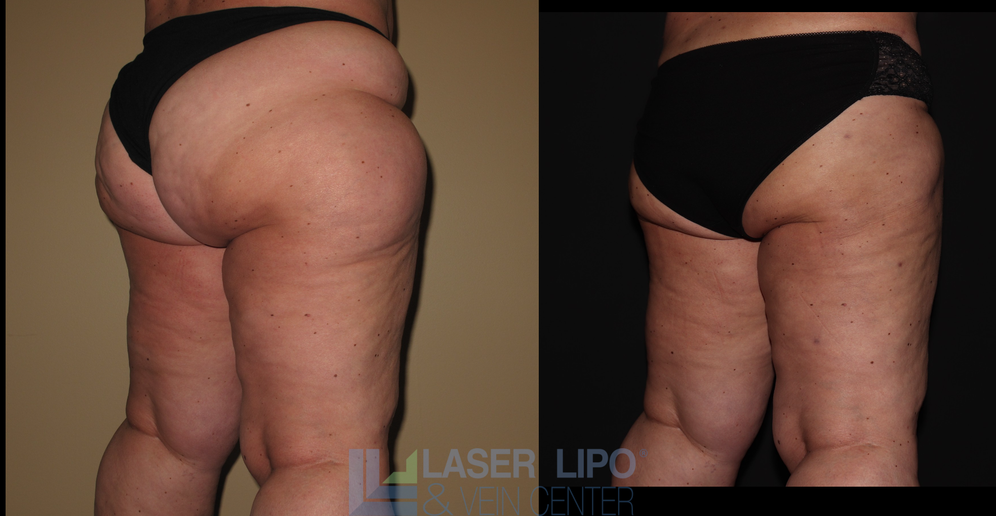 Before and After Image: Lipedema – Hips and Buttocks - right-back-oblique