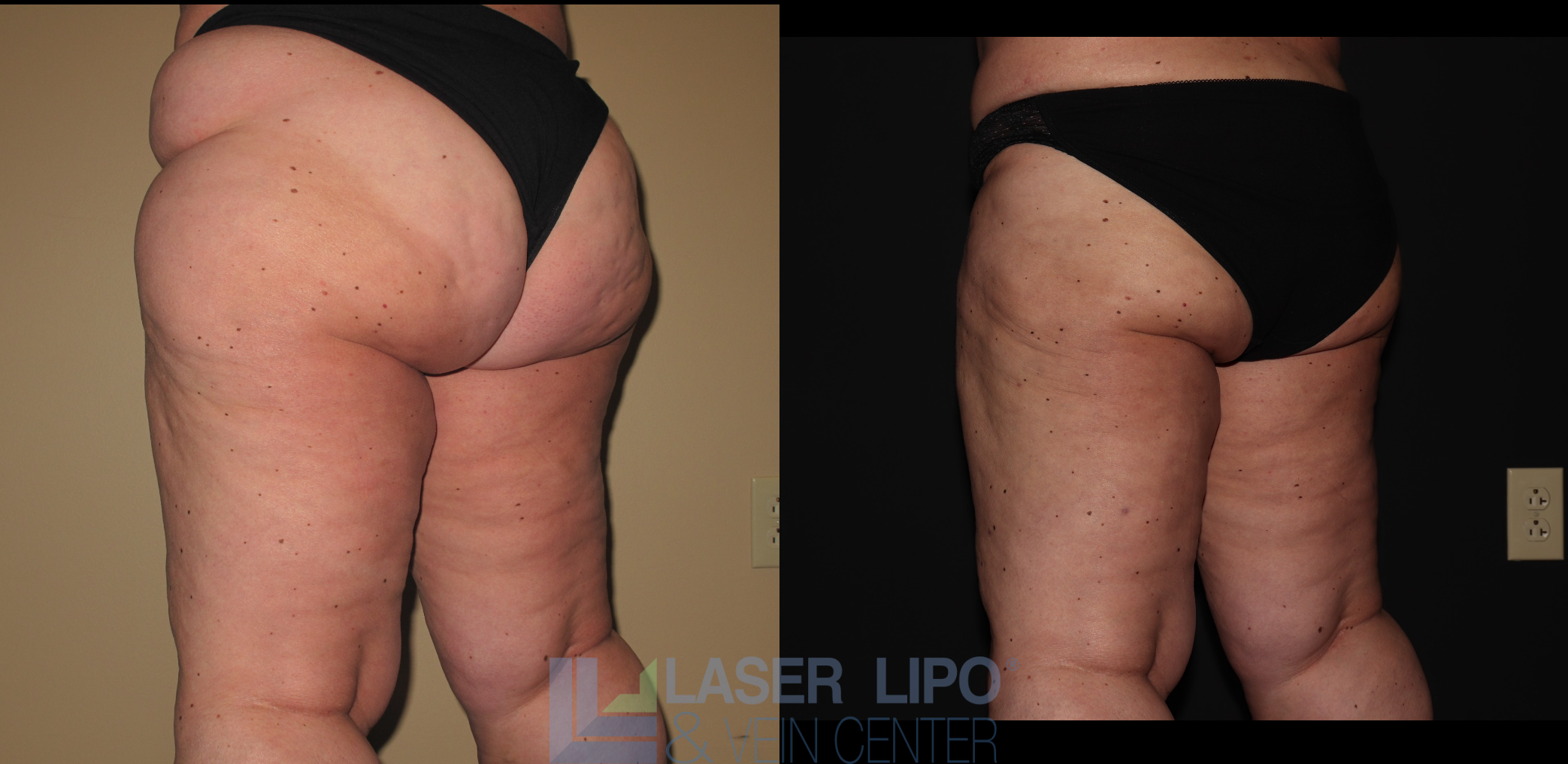 Before and After Image: Lipedema – Hips and Buttocks - left-back-oblique