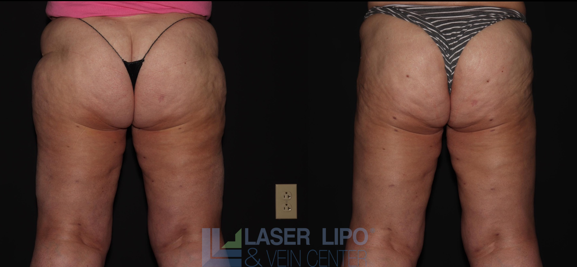 Before and After Image: Lipedema – Hips and Buttocks