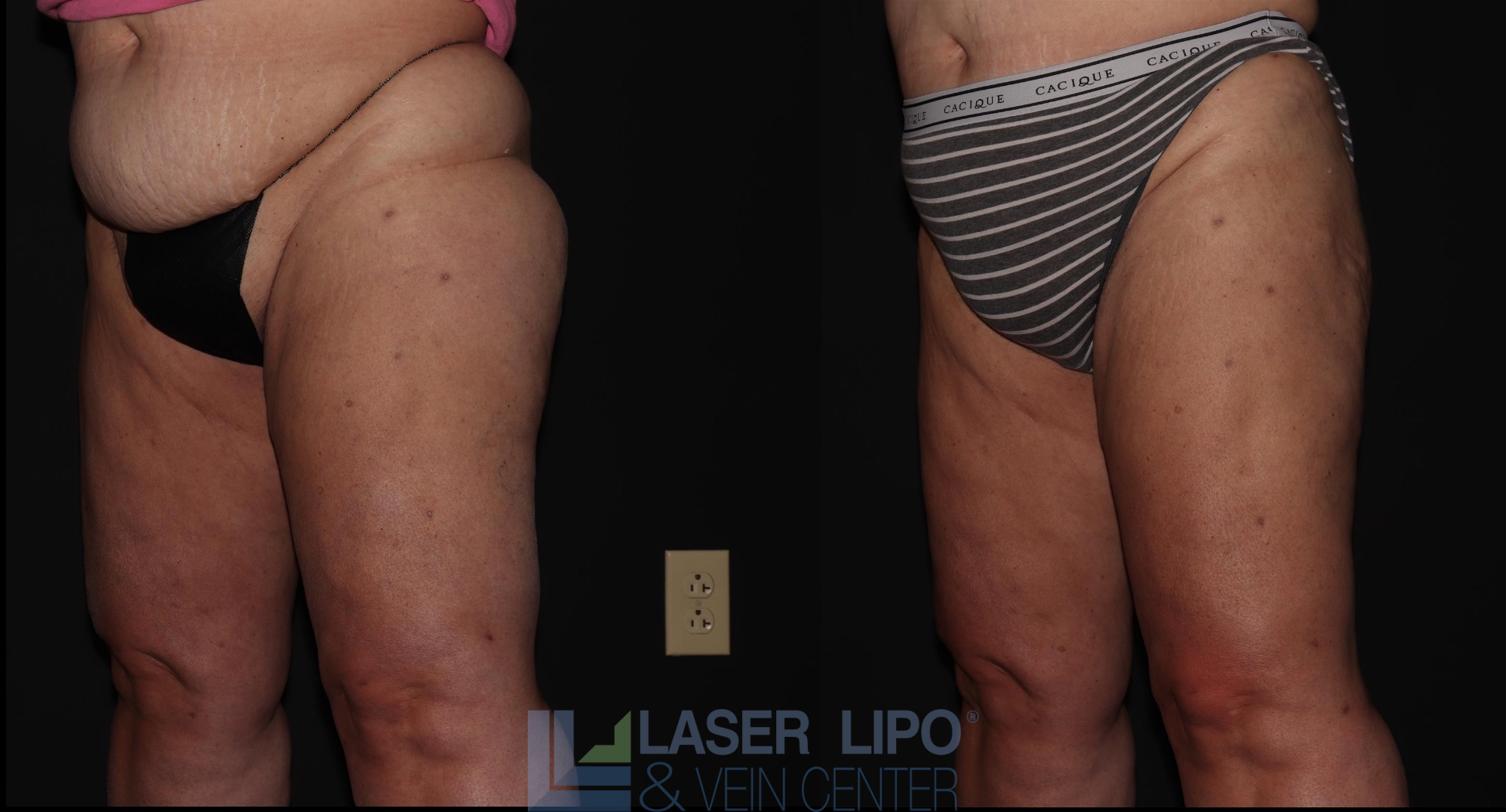 Before and After Image: Lipedema – Hips and Buttocks - left-front-oblique