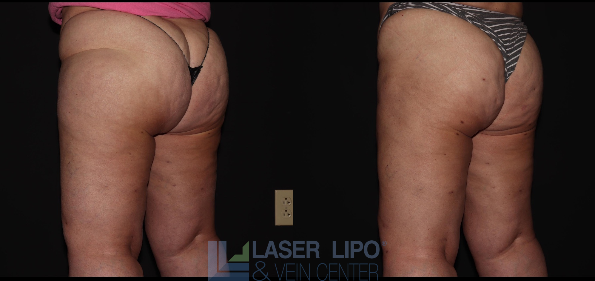 Before and After Image: Lipedema – Hips and Buttocks - left-back-oblique