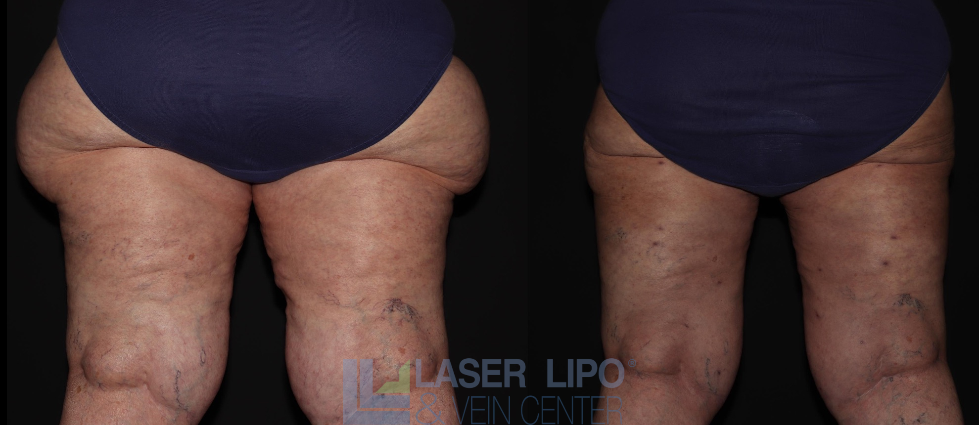 Before and After Image: Lipedema – Hips and Buttocks