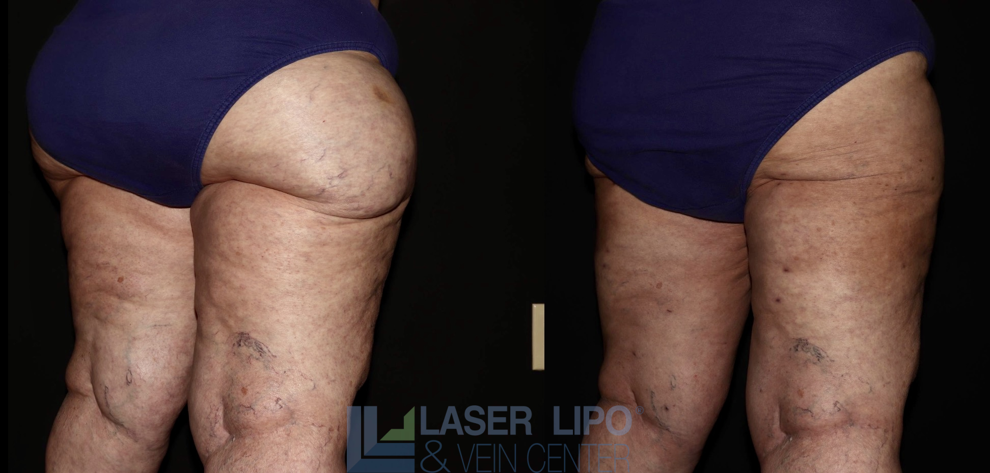 Before and After Image: Lipedema – Hips and Buttocks - right-back-oblique