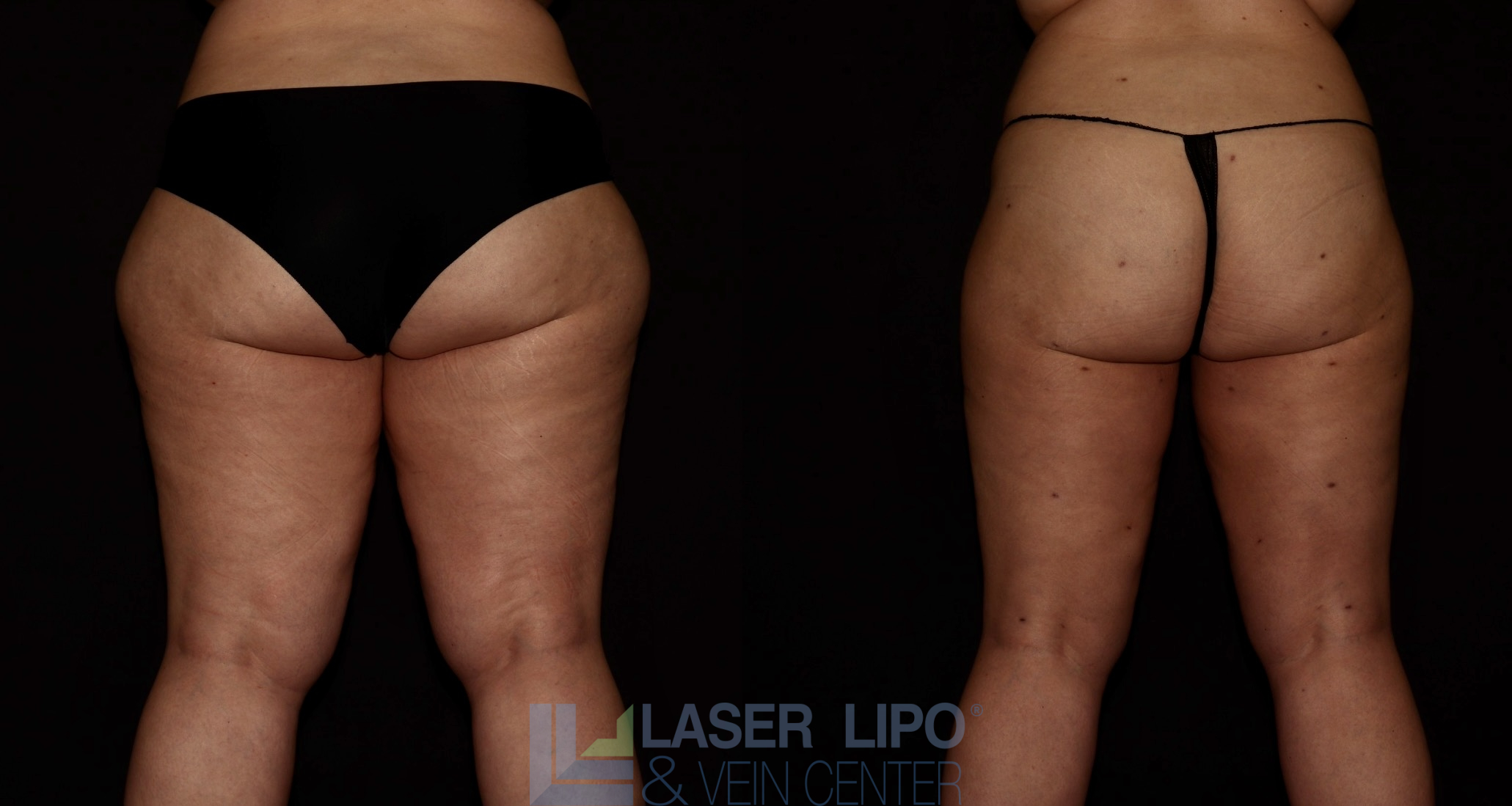 Before and After Image: Lipedema – Hips and Buttocks